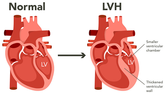 An illustration of a normal heart and a heart with left ventricular hypertrophy
