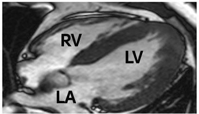 A scan of a heart with right ventricular hypertrophy